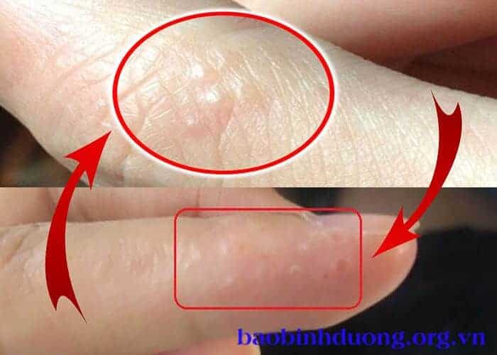 Mụn nước ở tay - Nguyên nhân và cách điều trị an toàn nhất