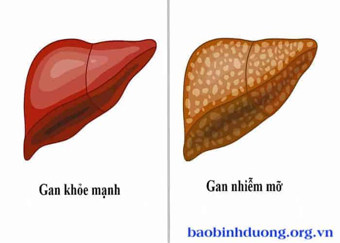 Hướng điều trị cho người gan nhiễm mỡ độ 2